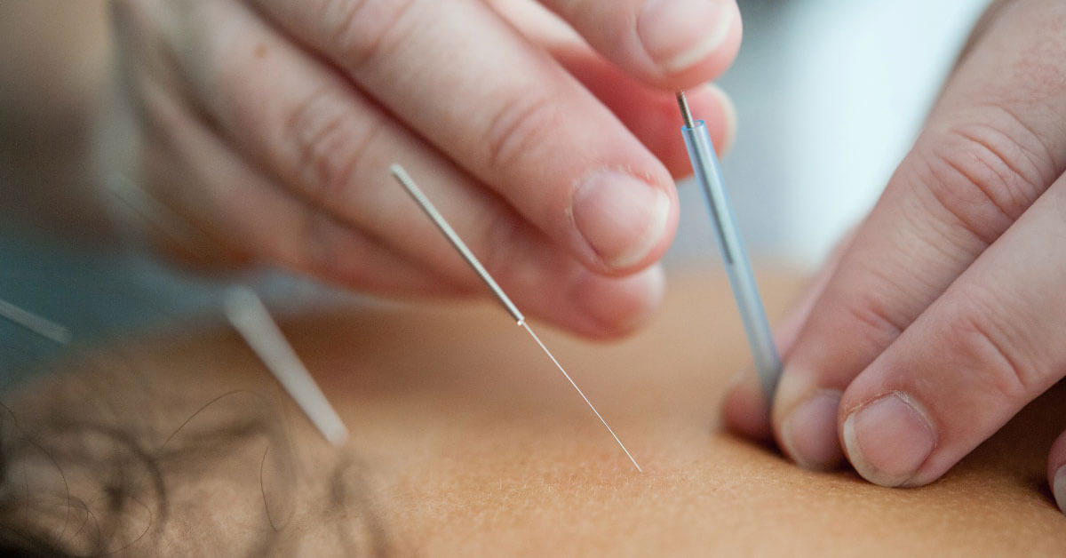 Dry Needling vs Acupuncture - what's the difference?